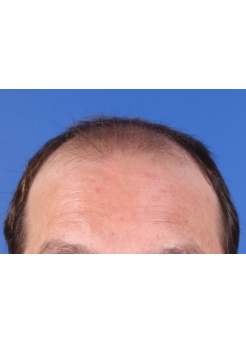 Before Hair Transplant&nbsp;2 Sessions (Areas)